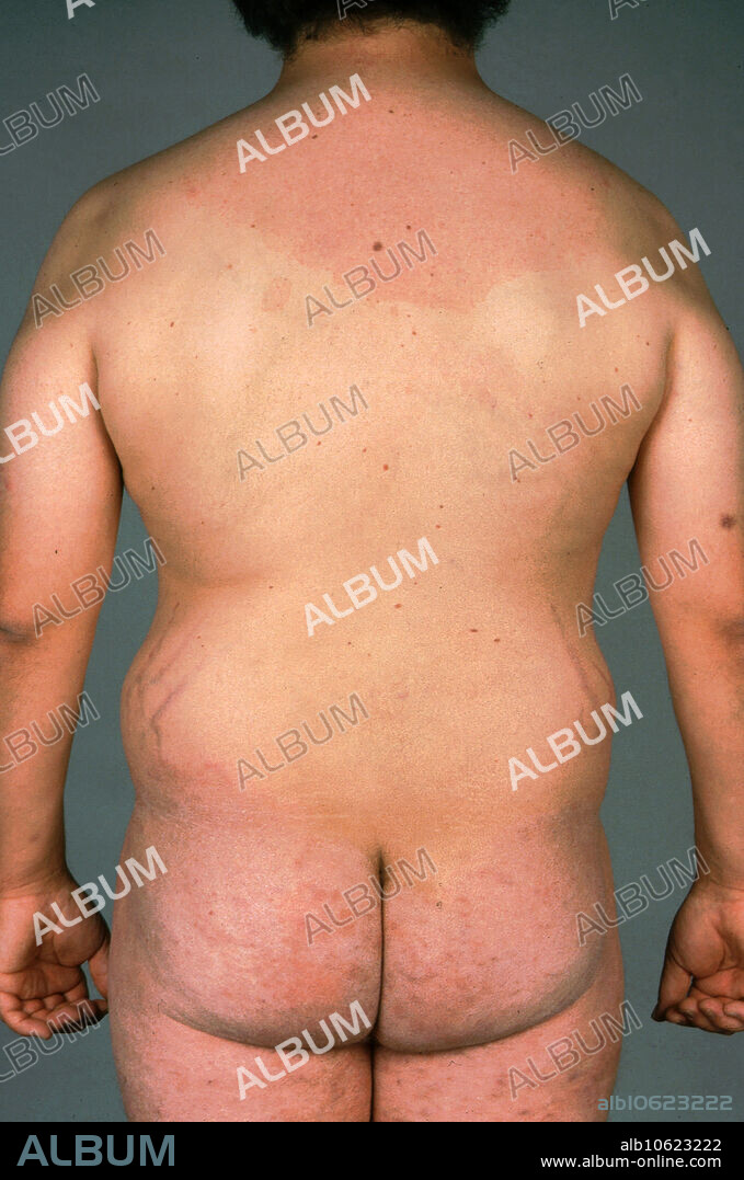 Tinea Corporis Album Alb