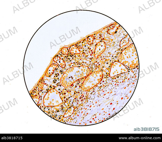 Congestion in Lungs, 1918 Influenza - Album alb3818715