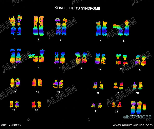 Klinefelter's Syndrome, Karyotype - Album alb3798022