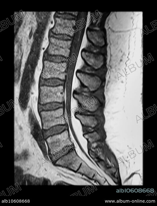 MRI Lumbar Epidural Lipomatosis - Album alb10608668