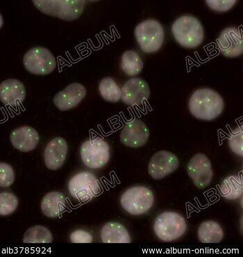 Breast Cancer. Cross-section of the Mammary Gland with Tumor Stock