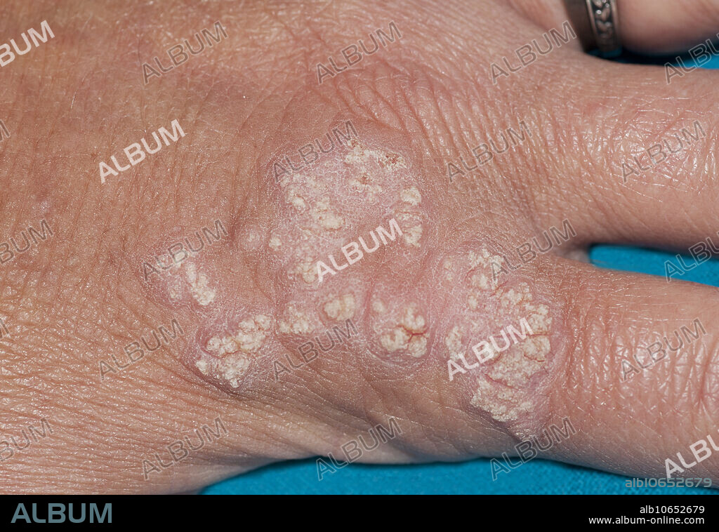 Hand lesions of ILVEN (Inflammatory linear verrucous epidermal nevus). Histologically, ILVEN skin lesions show hypergranulosis with orthokeratosis and parakeratosis with agranulosis. They are often raised and can be flakey or scabby. They are characterized as inflammatory because the lesions are warmer than surrounding skin. The lesions generally follow the lines of Blaschko, and are thus linear in arrangement.