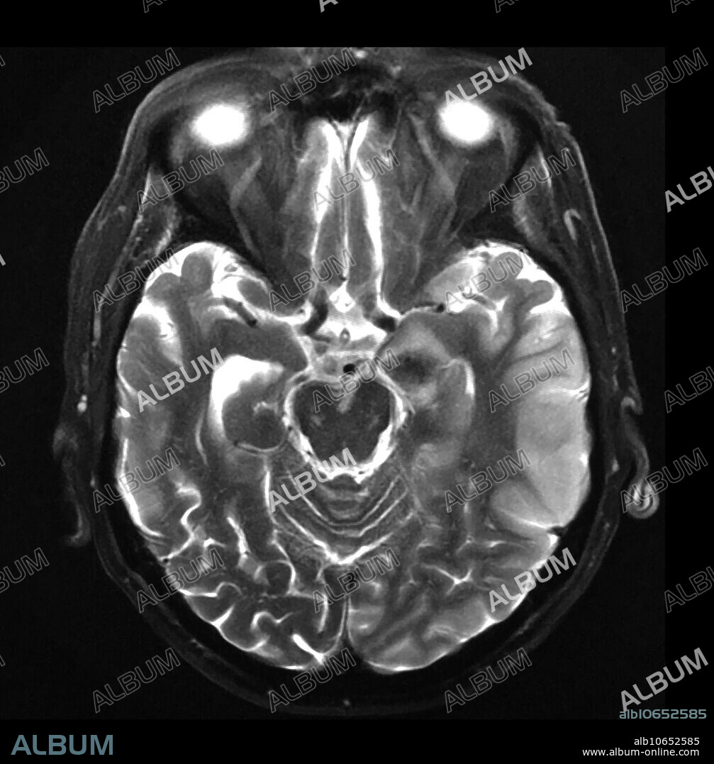 Haemorrhagic Infarction MRI - Album alb10652585