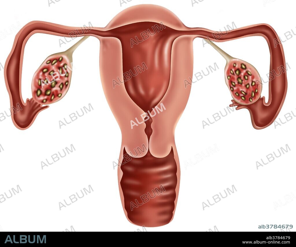 Illustration of polycystic ovaries. Ovarian cysts are collections of fluid surrounded by very thin walls within an ovary. There are many kinds, most of them benign.