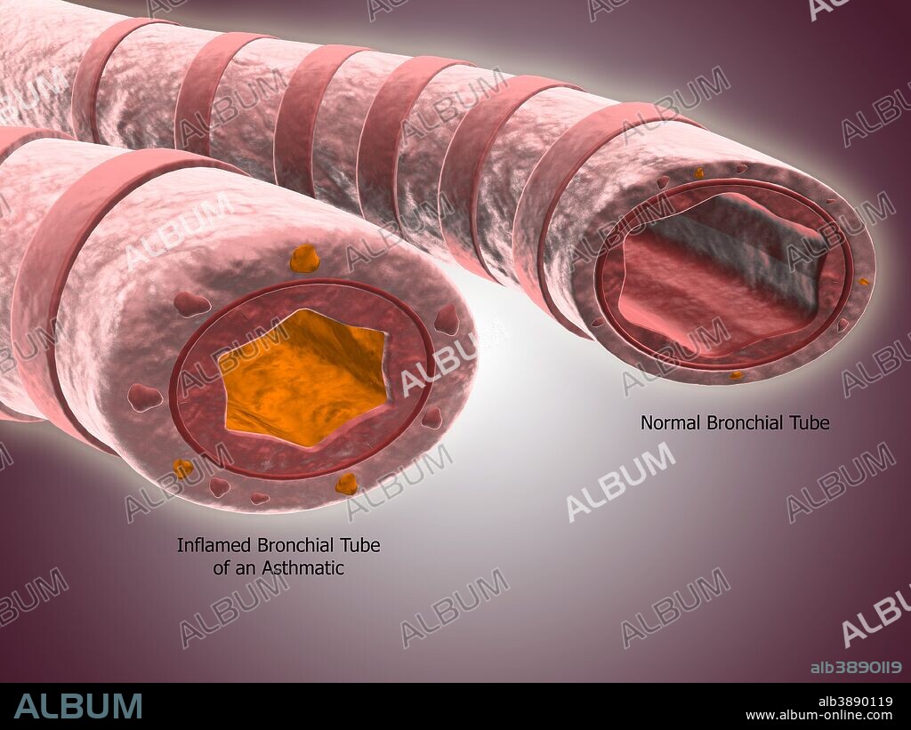 Trachea cross-section showing comparison of normal and asthmatic bronchiole.