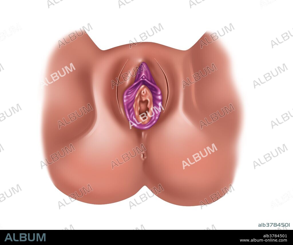 Total Excision of Clitoris & Labia - Album alb3784501