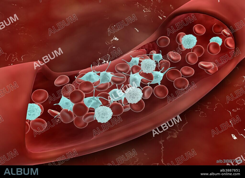 Microscopic view of blood clotting inside the artery.