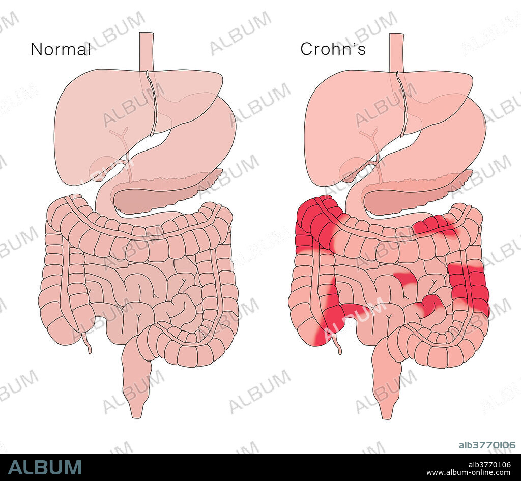 Digestive health and Crohns disease