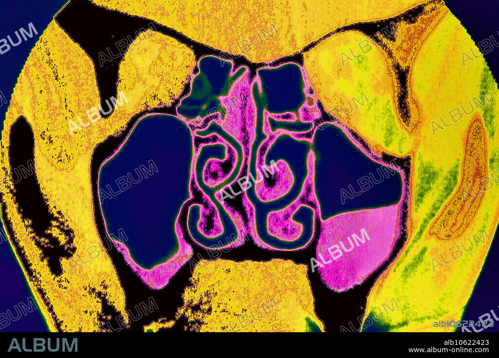 Maxillary sinusitis visualized by brain CT scan, front sectional.