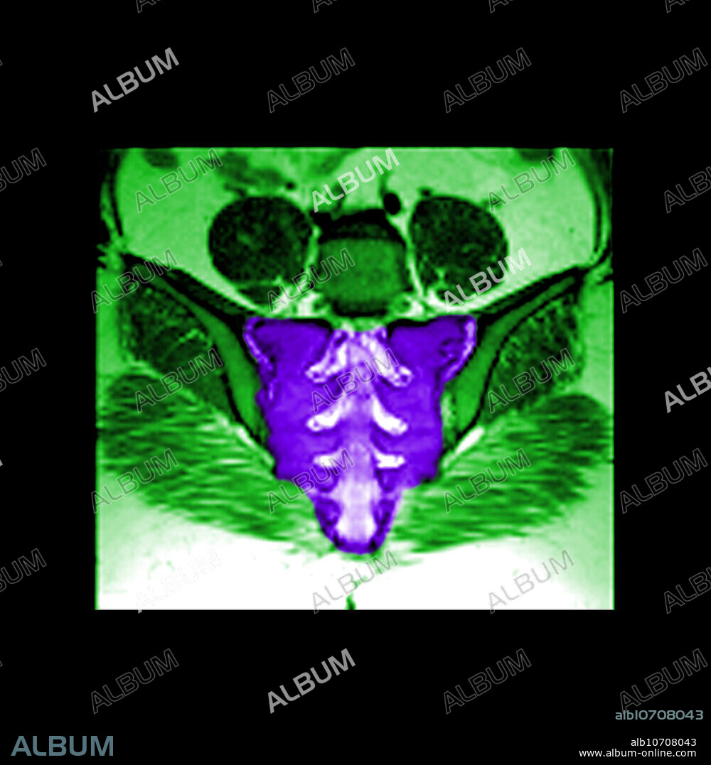 This color enhanced coronal (frontal) MRI image of the sacrum shows the normal anatomy of the sacrum, the sacroiliac joints, and the sacral neural foramina. MRI is an excellent tool to evaluate the sacrum, for most pathology.