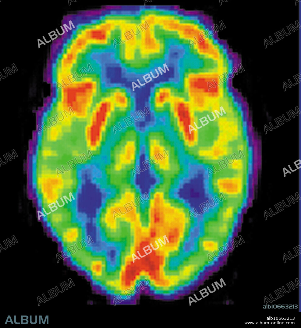 PET Scan of 80-year-old Brain, 2 of 2 - Album alb10663213