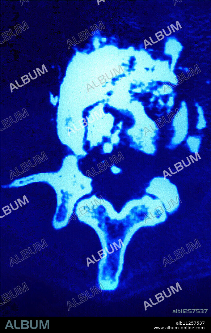 Lumbar vertebra fracture, seen on a cross-section vertebral scan.