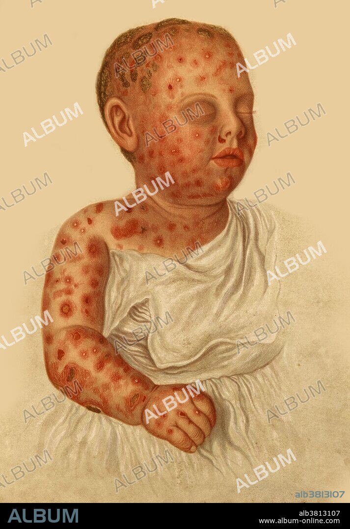 Pruriginous impetigo following varicella. Prurigo is an itchy eruption on the skin and impetigo is a bacterial skin infection. The two together present as a red itchy contagious skin rash. The notes on the illustration indicate the condition may have erupted following the viral infection varicella (chicken pox) or perhaps the varicella vaccine. Chromolithograph, 1878-1888. Illustration by E. Burgess after R. W. Sherwin, Mabel Green and Jonathan Hutchinson.