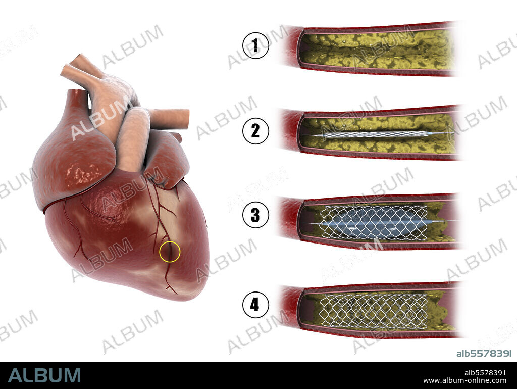 Diagram showing procedure of balloon angioplasty to widen obstructed arteries in heart.