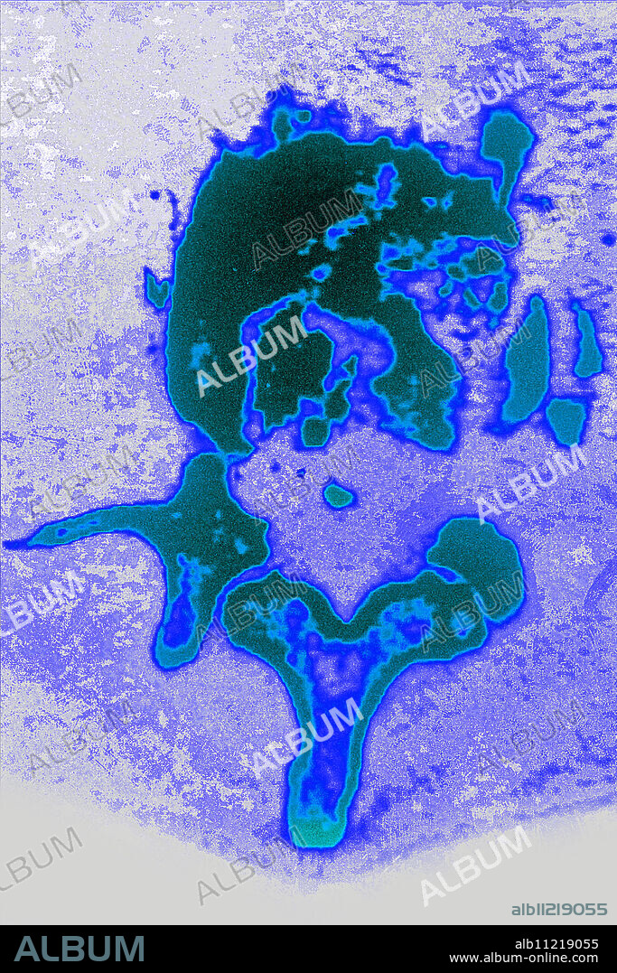 Lumbar vertebra fracture, seen on a cross-section vertebral scan.