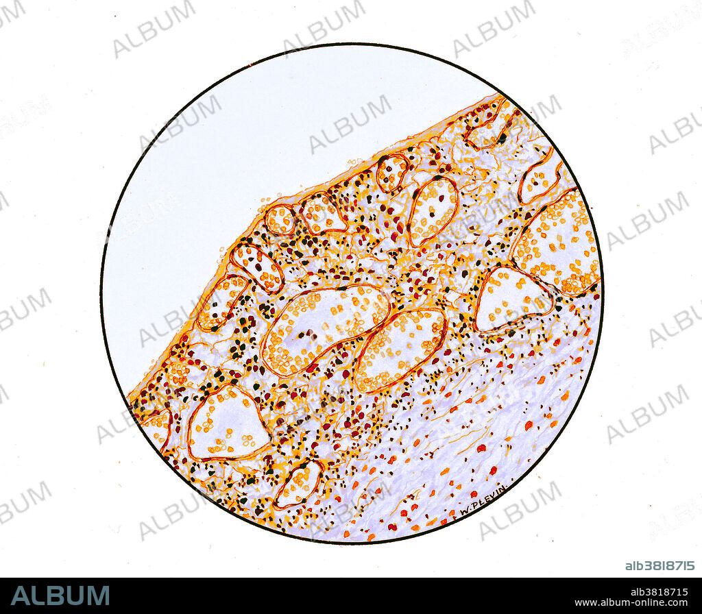 Drawing of the 1918 influenza in lungs: Main bronchus of a set of influenza lungs, showing congestion of vessels and infiltration of round cells, including thickening of the membrane. John George Adam, 1920-21. The 1918 flu pandemic (lasting from January 1918 to December 1920) was an unusually deadly influenza pandemic, the first of the two pandemics involving H1N1 influenza virus. It infected 500 million people across the world, including remote Pacific islands and the Arctic, and killed 50 to 100 million of them - three to five percent of the world's population - making it one of the deadliest natural disasters in human history.