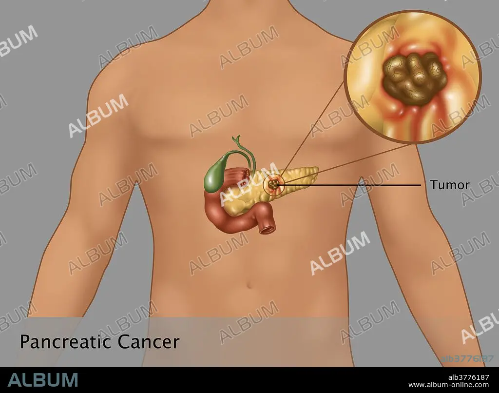 Pancreatic Cancer in Male Figure, Illustration - Album alb3776187