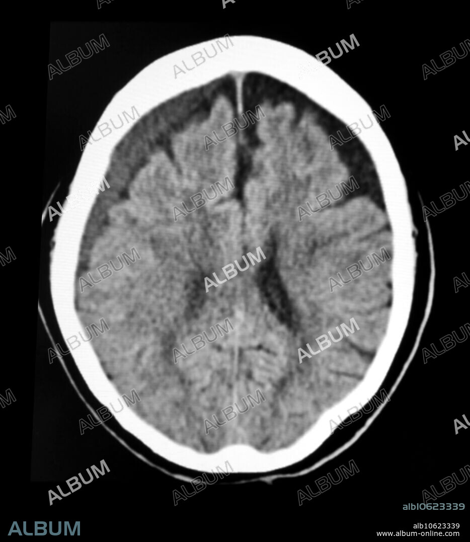 This axial (cross sectional) CT image of the head shows a subacute subdural hematoma over the surface of the cerebral hemisphere on viewers left. As intracranial haemorrhage (bleeding) evolves and matures they become less dense (less white) over time.