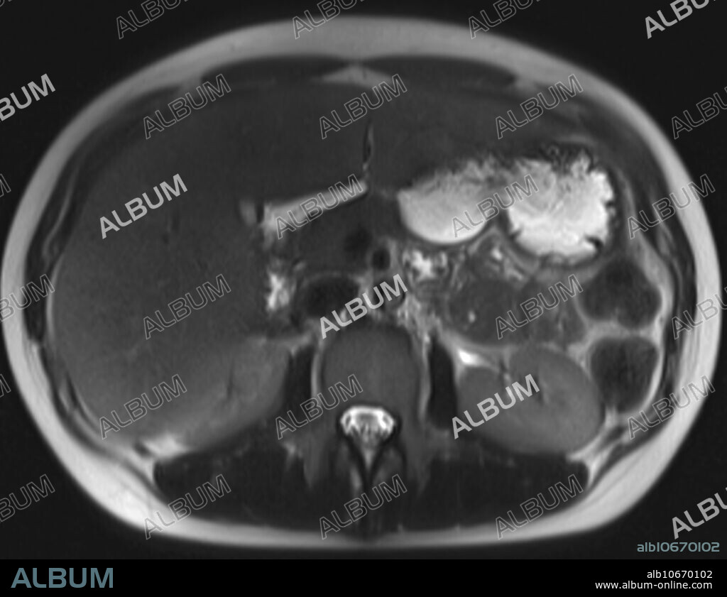 Normal T2 weighted axial MRI enterography of abdomen, lumbar spine and sacrum in 16 year old female at level of L2.