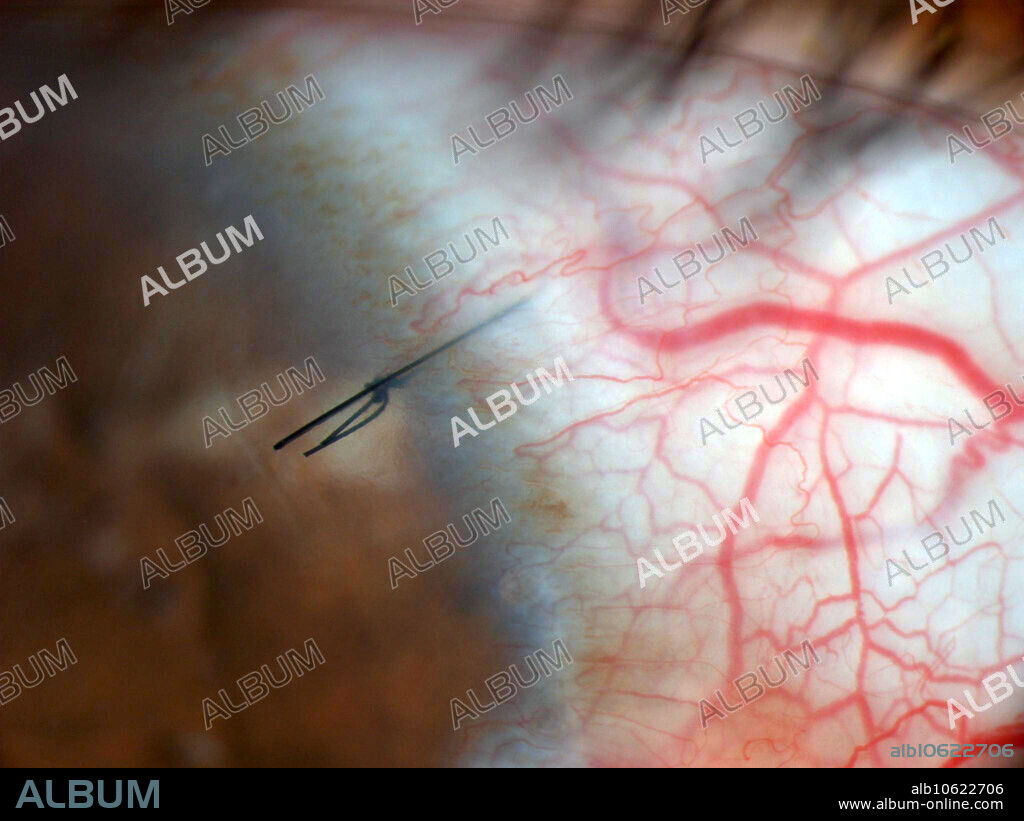 Suture closing a corneal incision.