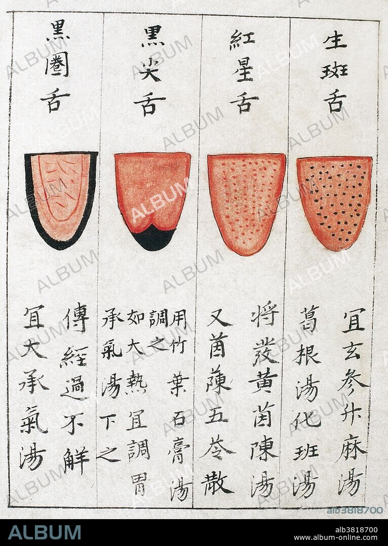 Chinese tongue diagnosis chart. Illustrations of 'spotted' (sheng ban), 'red star' (hongxing), 'black tip'(hei jian) and 'black border' (hei quan) tongue from a manuscript copy of Shanghan diandian jin shu (The Gold-dust Book of Cold Damage) dated '1st year of the Zhengyuan reign period of the Yuan dynasty' (1341), section entitled Yanzheng she (Examining the Tongue). This book incorporates the teachings of Ao Jiweng (Song period, 960-1279) on the movement of Qi and those of Du Ben (Tao Hua) (Yuan period, 1206-1368) on pulse and tongue diagnosis, etc. Yanzheng she is based on an original text by Ao Jiweng, edited by Chen Shiwen and Shi Buni (Song period). It is a guide to the diagnosis of cold damage conditions according to the coating of the tongue, with 36 illustrations in colour.