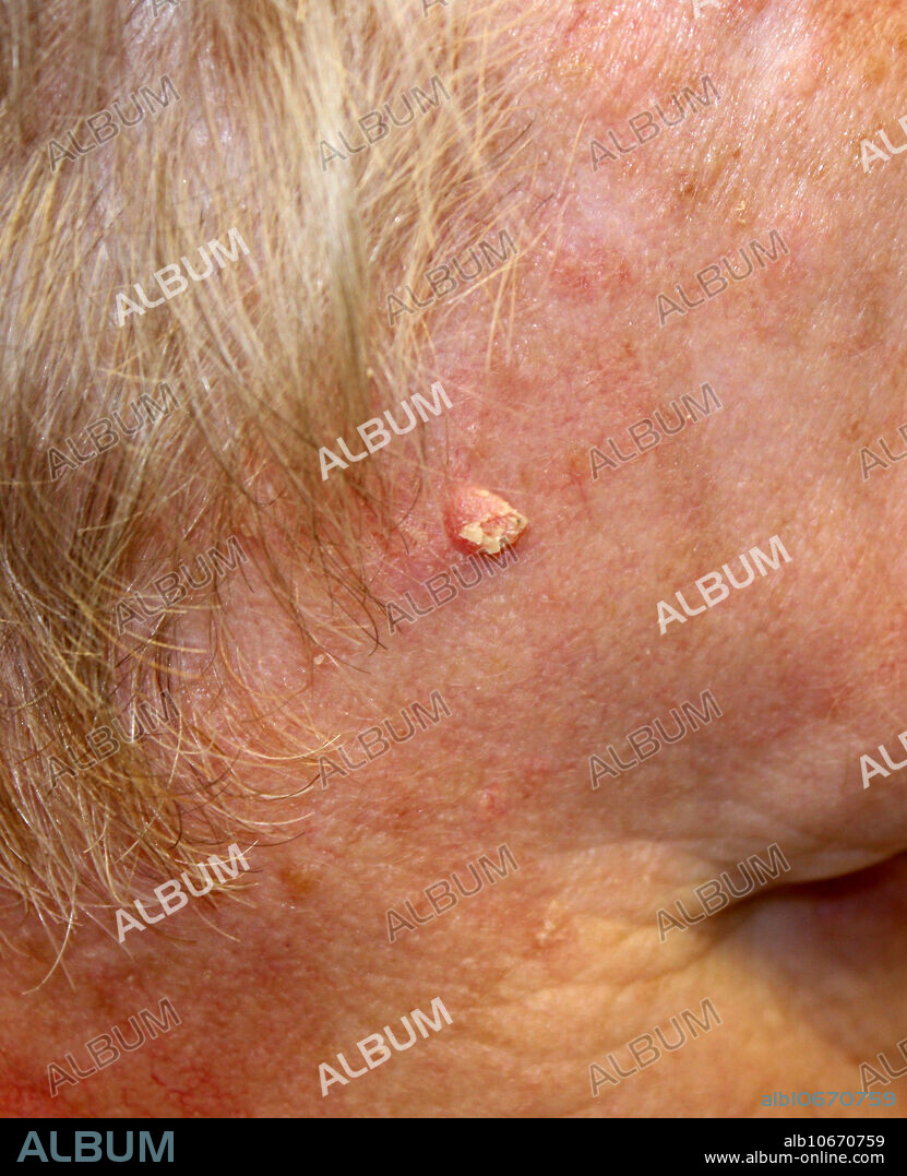 Squamous cell carcinoma on the side of a person's face. This skin cancer lesion is raised and crusty.