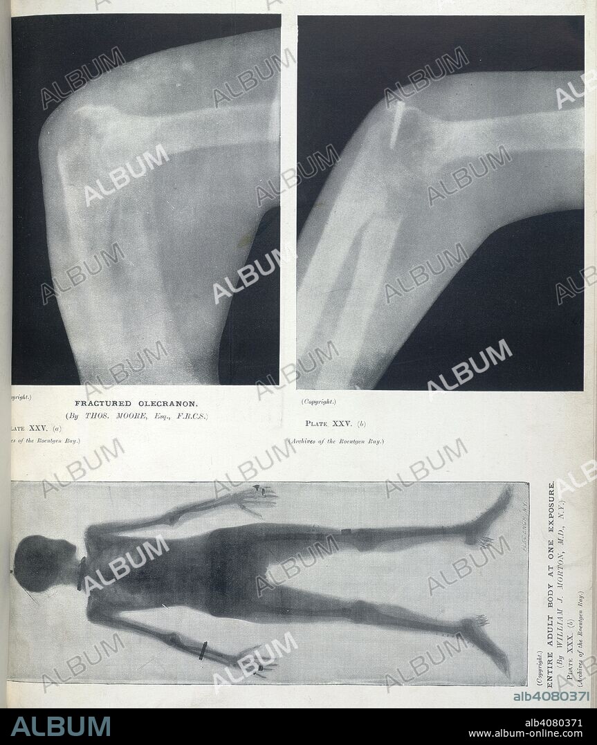 Plate XXV. (a): Fractured olecranon. (By Thos. Moore, esq. F.R.C.S.) Plate  XXV. (b): As above. Plate XXX. (b): Entire adult body at one exposure. (By  William J. Morton. M. - Album alb4080371