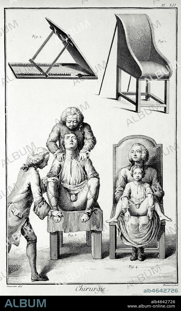 Chirurgie, Mise en position pour l'operation de la taille (vessie et autres visceres) : gravure tiree de l'encyclopedie Diderot et D'alembert en 1763. Credit : Coll. Coll. Jonas/KHARBINE-TAPABOR.