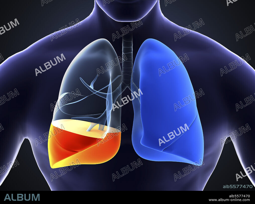 Medical illustration showing pneumonia in the human lungs.