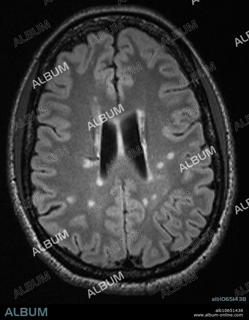 Multiple sclerosis, MRI - Album alb10651438