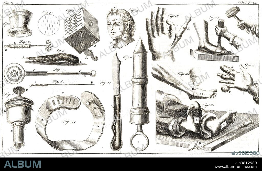 A selection of 18th century instruments used in cupping and amputations. Fig 1 to 3: Items used in cupping, including cupping glass, scalpel or scarificator and representation of the cutting marks on the skin that are to be covered by the cupping glass. Fig 4: A cubical scarificator (maker of the marks in fig 3). Fig 5: A representation of a leech. Fig 6 and 7: A needle and hammer used in acupuncture. Fig 8: A cauterizing iron. Fig 9: A leather swath used instead of deligation for issues in the arm. Fig 10: A syringe used for injections in the urethra and vagina. Fig 11: The soles of the feet that the Italian physician Mistichellius directs to be cauterized in Apoplexies. Fig 12: Representation of the method of burning the part affected by gout with the Indian moxa. Fig 13: Several encysted tumors on the face and neck. Fig 14: A scalpel used in extracting tumors of the neck or glands. Fig 15: A hand of an infant with six fingers, the sixth finger being later amputated by using the scalpel. Fig 16: Various afflictions to the hand prior to them being amputated. Fig 17: Method of amputating the big toe by the use of a mallet and chisel. Engraving, 1743.