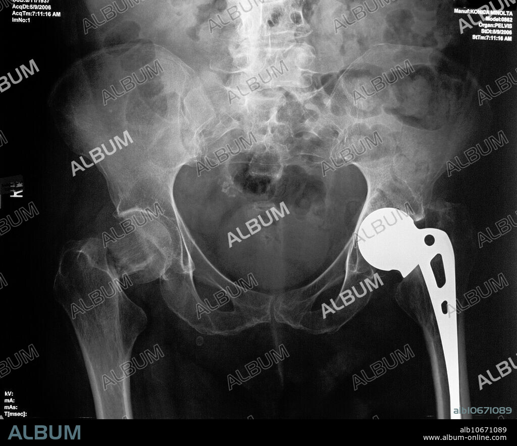 X-Ray showing a hip replacement (right) and a new hip fracture (left) in a 69 year old woman.