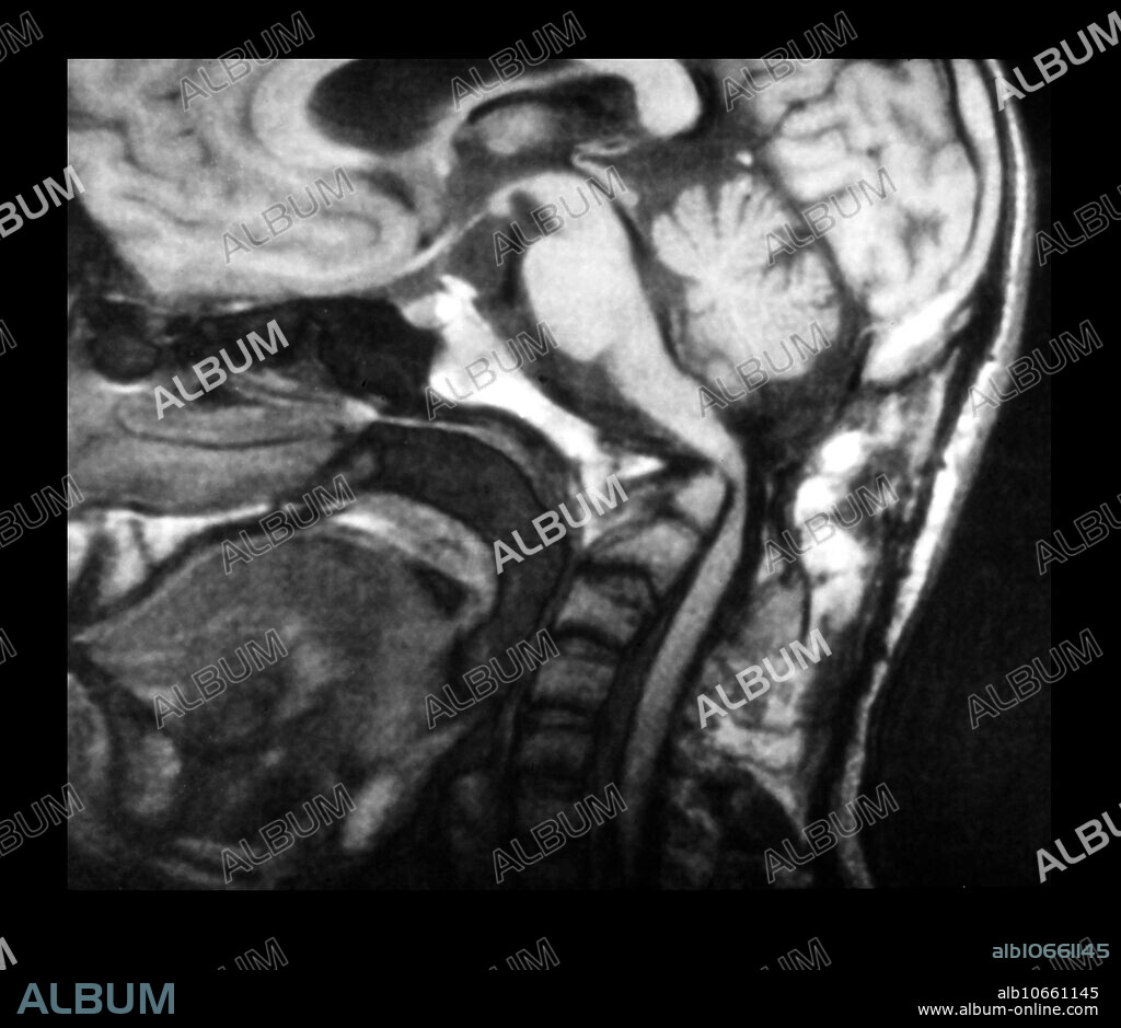 This sagittal (from the side) MRI of the brain and cranio-vertebral junction shows a severe form of basilar invagination, which is the upward protrusion of the odontoid into the foramen magnum. This causes severe compression of the cervico-medullary junction.