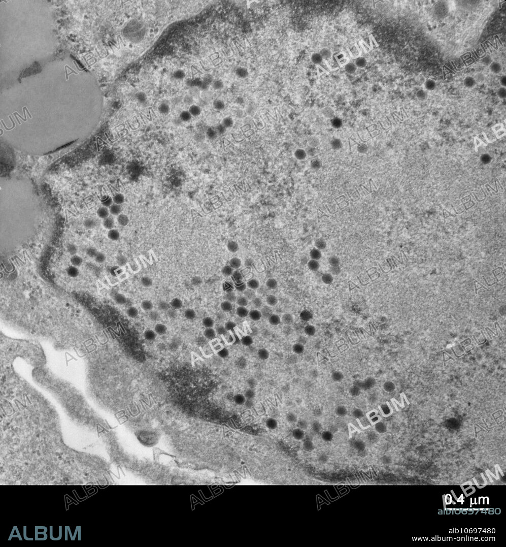 Transmission electron micrograph (TEM) of intranuclear particles of adenovirus in mammalian airway epithelium. Viral particles are evident as electron dense orthogonal structures. Magnification 20,000x.