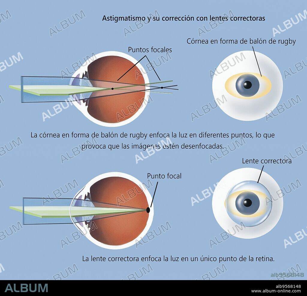 Astigmatism and correction with corrective lens.