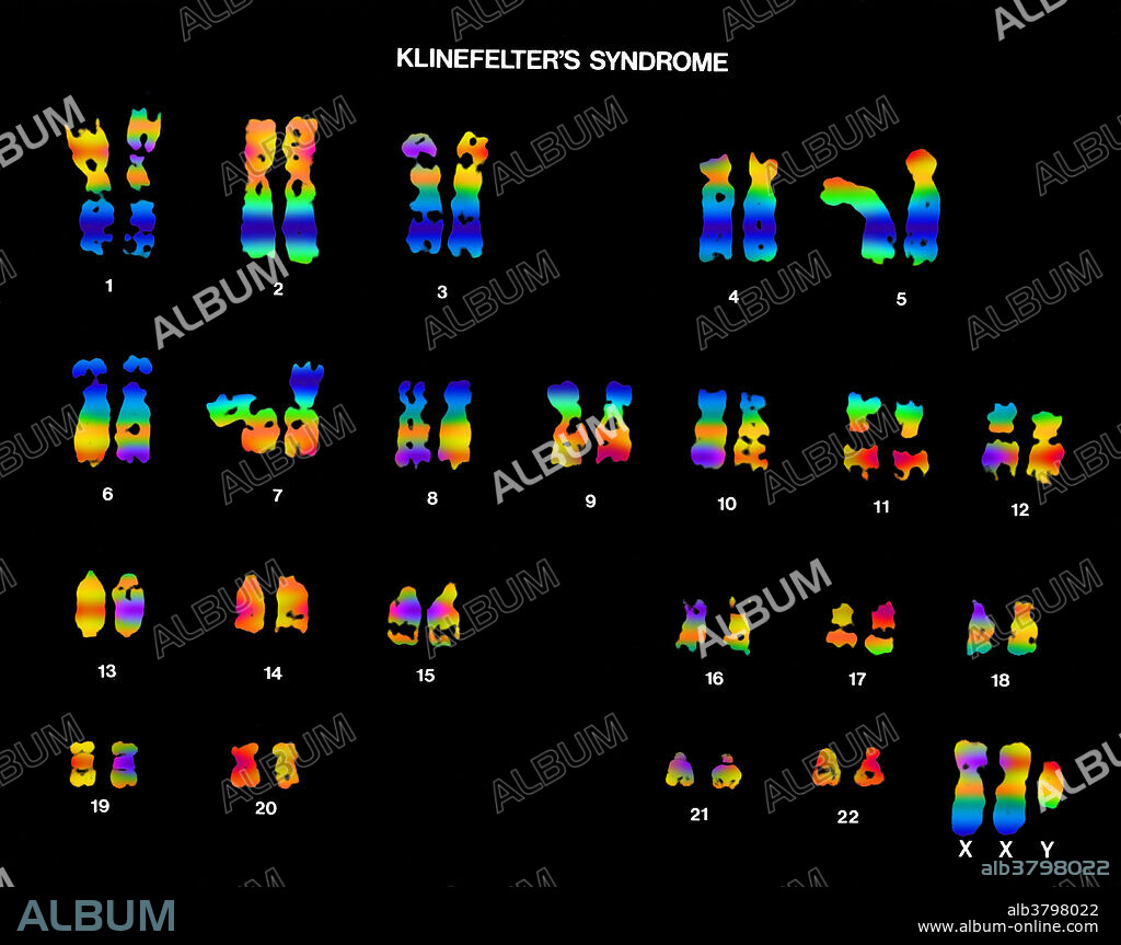 Colour enhanced micrograph of a karyotype showing Klinefelter's syndrome, a common chromosomal abnormality in which one or more extra X-chromosomes are present in a male. It results in small testicles and the inability to make sperm. Additionally, affected males may have learning disabilities and/or behaviour problems.