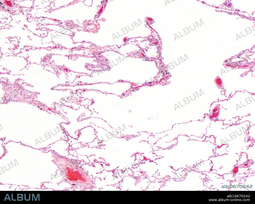 Lung, human, emphysema, HE stain, 25X. Light micrograph.