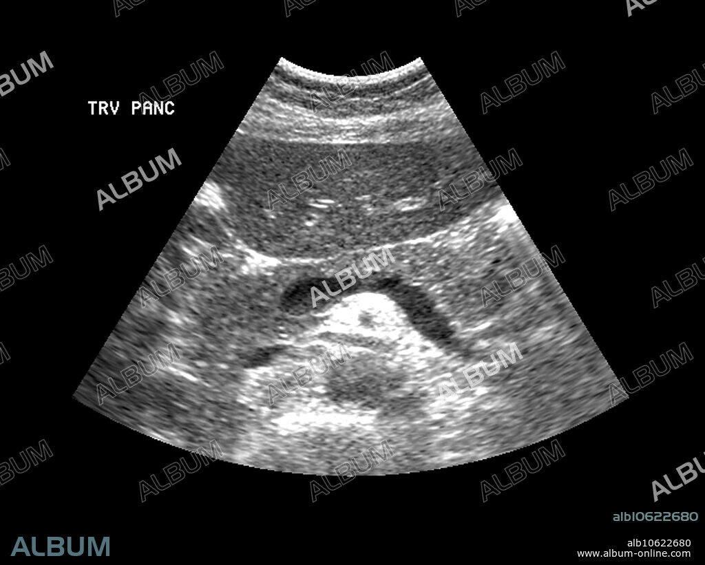 This axial (cross section) ultrasound image of the epigastric region shows a nice example of the normal appearance of the pancreas anterior (towards the top) to the splenic vein. Near the top of the image is the left lobe of the liver.