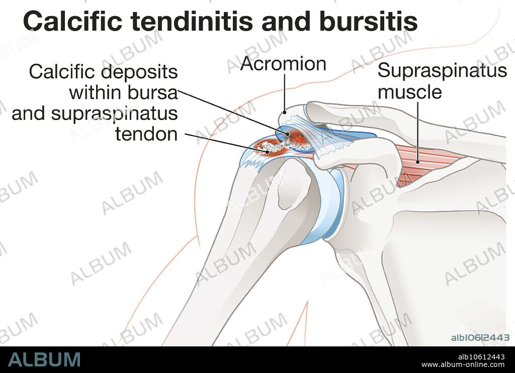 Calcific tendinitis and bursitis in shoulder, illustration - Album ...