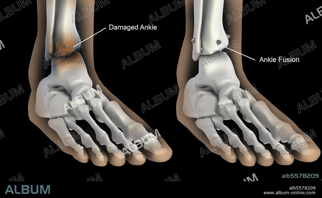 Biomedical illustration showing ankle fusion.