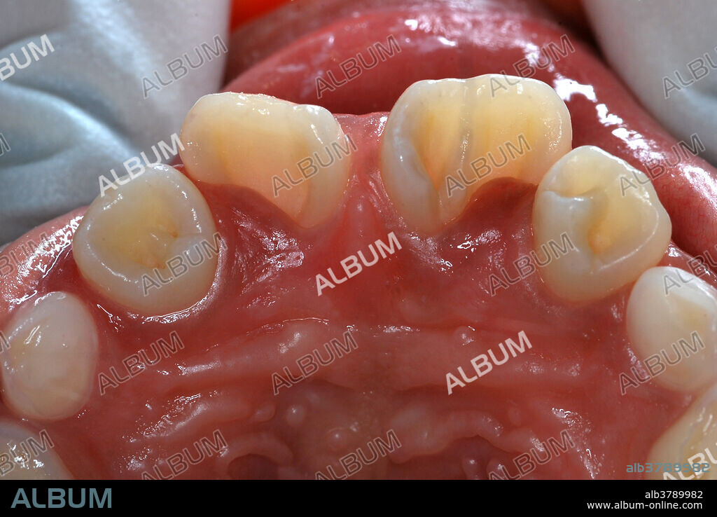 Dens in Dente Malformation of teeth #s 7, 9, and 10 (maxillary right and left lateral incisors, and maxillary left central incisor). Dens in Dente ( tooth within a tooth ), also known as Dens invaginatus, is where the outer surface of the tooth folds inward. Image before restorative procedures.