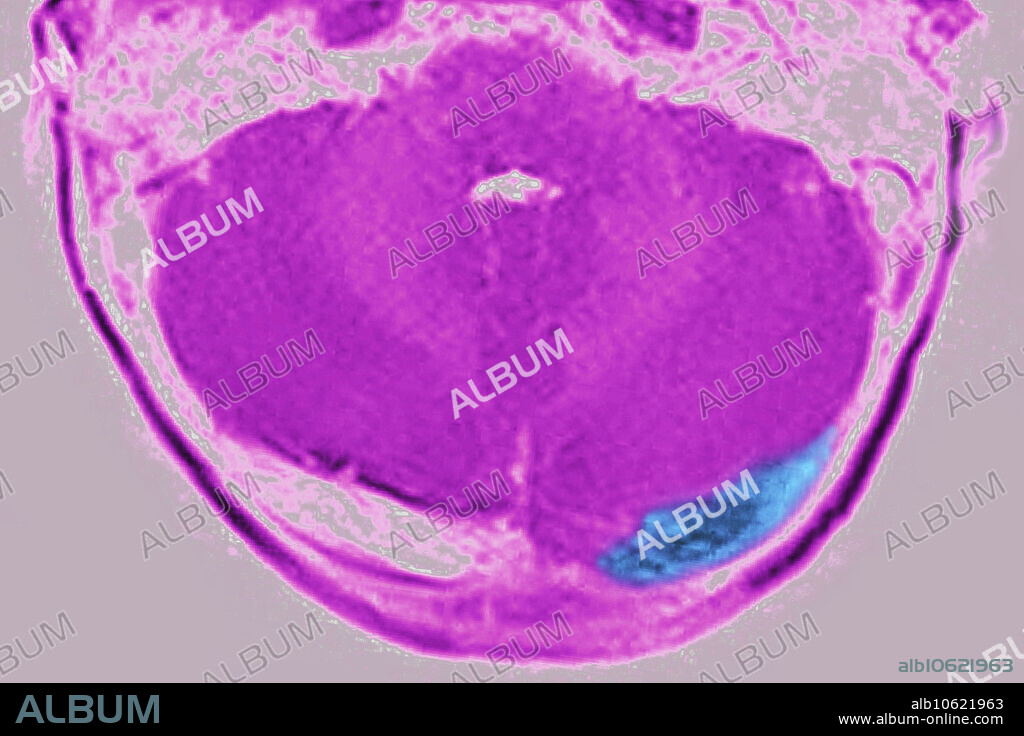 Childhood cerebral venous thrombosis (venous occlusion). Radial MRI (magnetic resonance imaging) scan of the skull.