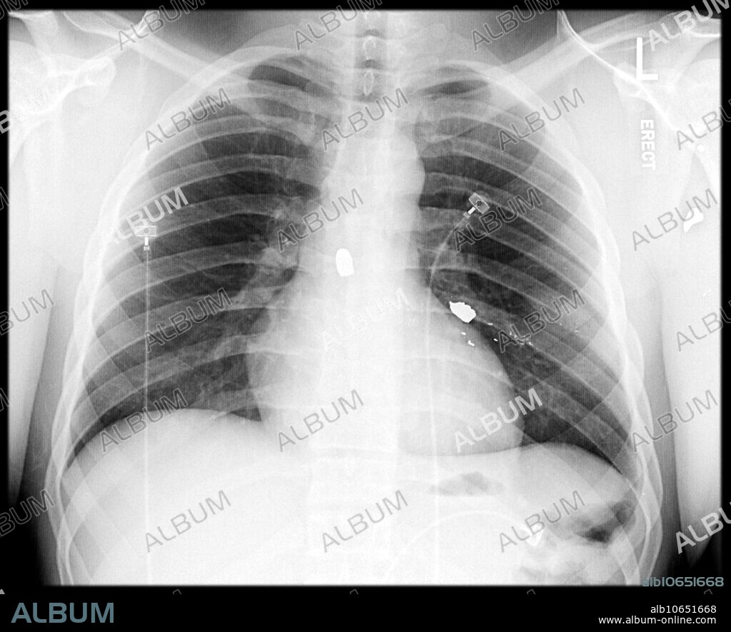 This frontal chest x-ray shows multiple bullet fragments lodged in the soft tissue of the chest. These show up as very white because of the metal content.