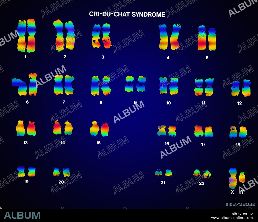 Colour enhanced micrograph of a karyotype of a patient with cri du chat syndrome (also known as Cat cry syndrome). Cri du chat syndrome is a group on syndromes including mental retardation, high-pitched cry sounds (like a cat), microcephaly, low birth weight, hypertelorism, a small jaw, low-set ears, partial webbing of fingers or toes, skin tags in front of the ear, slow development of motor skills, and a simian crease in the palm of the hand. The syndrome is caused by missing information on chromosome 5.