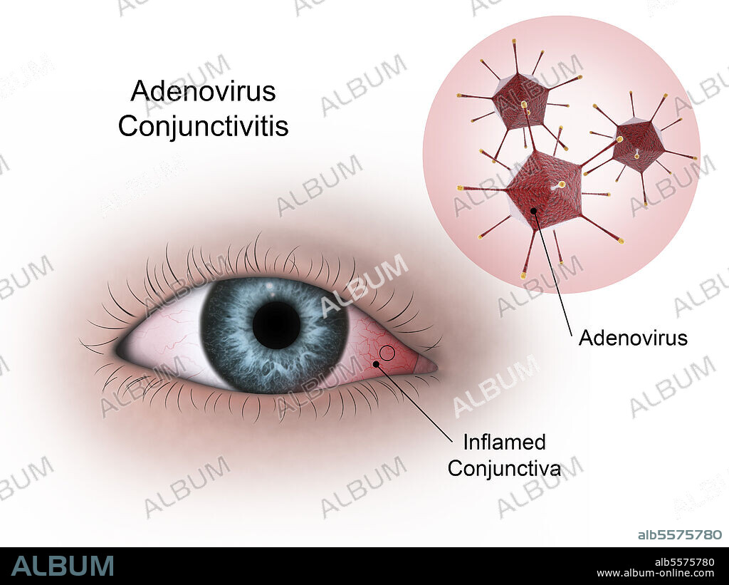 Medical illustration of viral conjunctivitis in the eye, caused by the adenovirus.