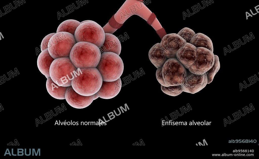 Medical comparison of healthy alveoli and an unhealthy emphysema alveoli.