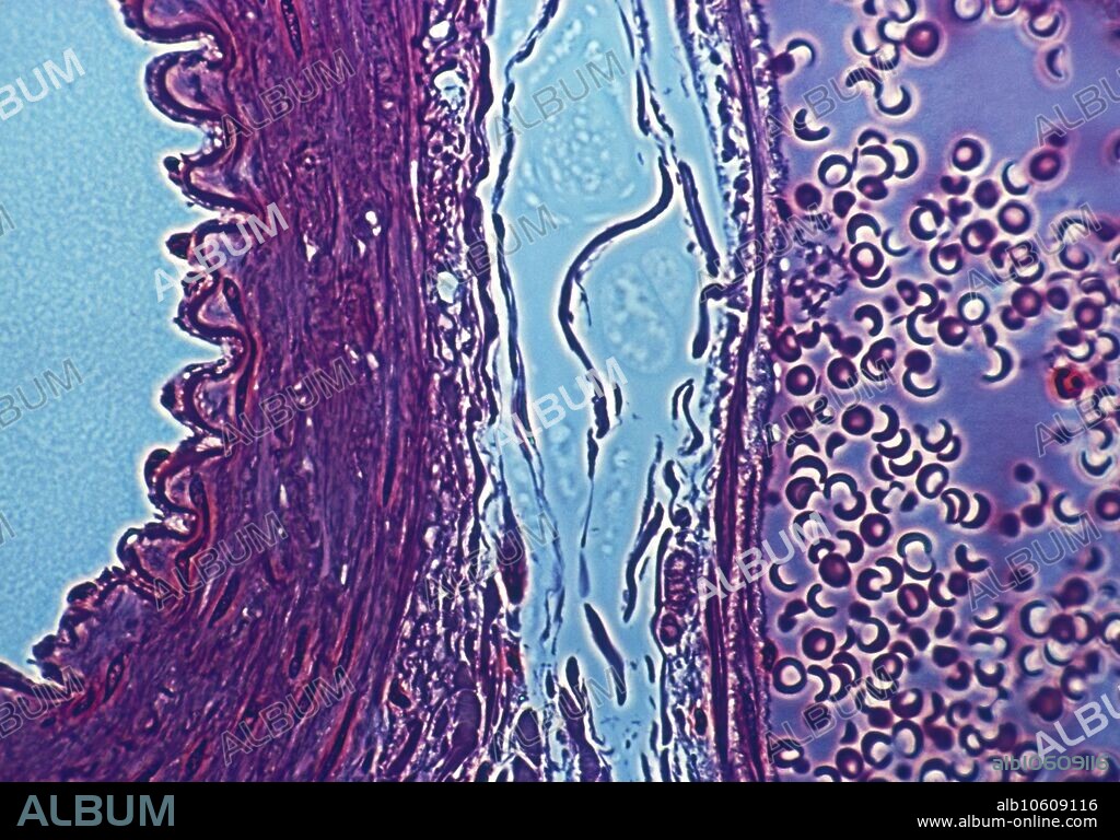 Artery and vein. Light micrograph of a cross- section of a human artery and a longitudinal section of a vein. The artery (at left, purple) surrounds a central cavity (blue). The artery's corrugated inner surface layer (internal elastic lamina) is comprised of an elastic protein (elastin, purple). Surrounding is a layer of smooth muscle. Arteries carry blood from the heart to the rest of the body, and so must withstand high pressure blood. The vein (purple, at right) is filled with rounded blood cells. This vessel has thin walls because it carries low-pressure blood from the body to the heart. Magnification: x160 at 35mm size.