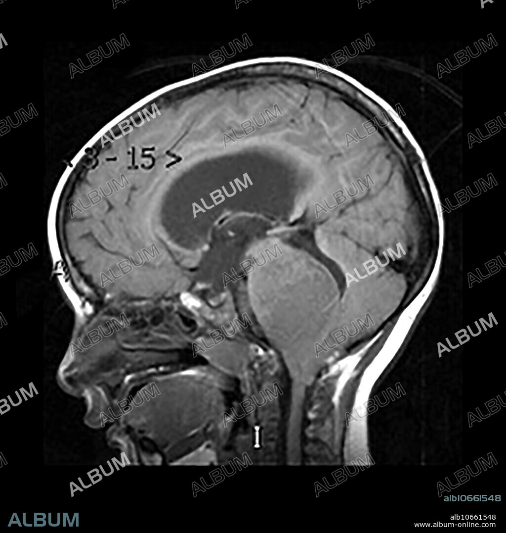 This sagittal (from the side) T1 weighted MR image shows marked expansion of the brainstem centered at the level of the pons representing a diffuse (Grade II) glioma of the pons.