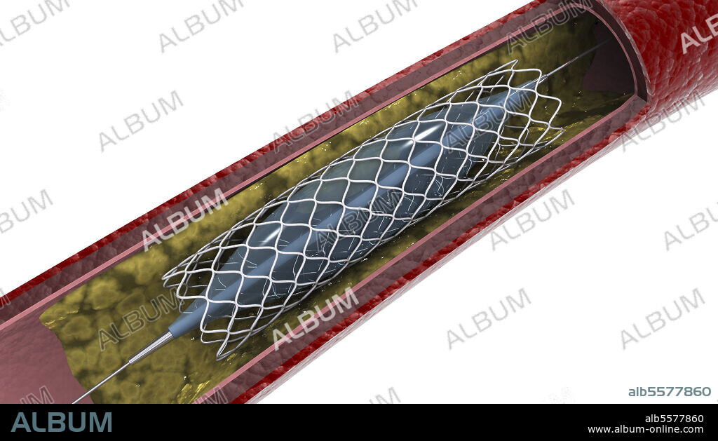 Cross-section of artery showing angioplasty and stent deployment.