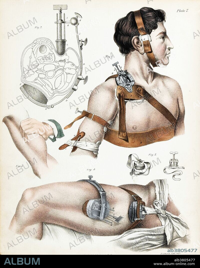 Schematic drawing showing the operative technique chosen for patients